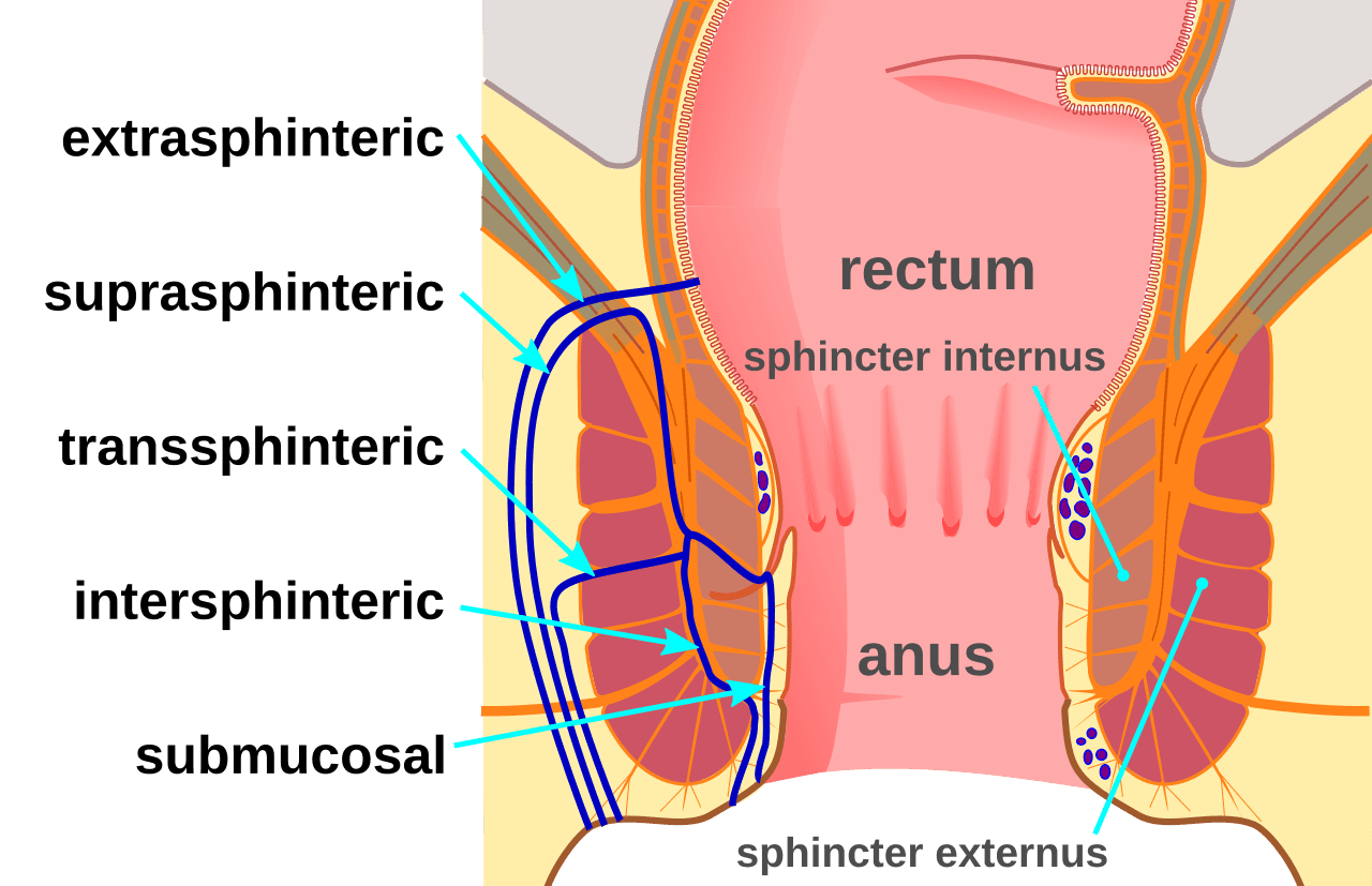 Fistula Diagram