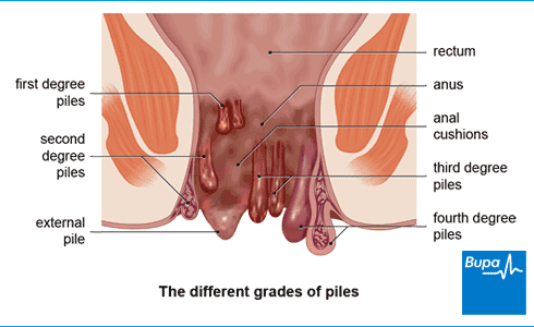Piles Diagram