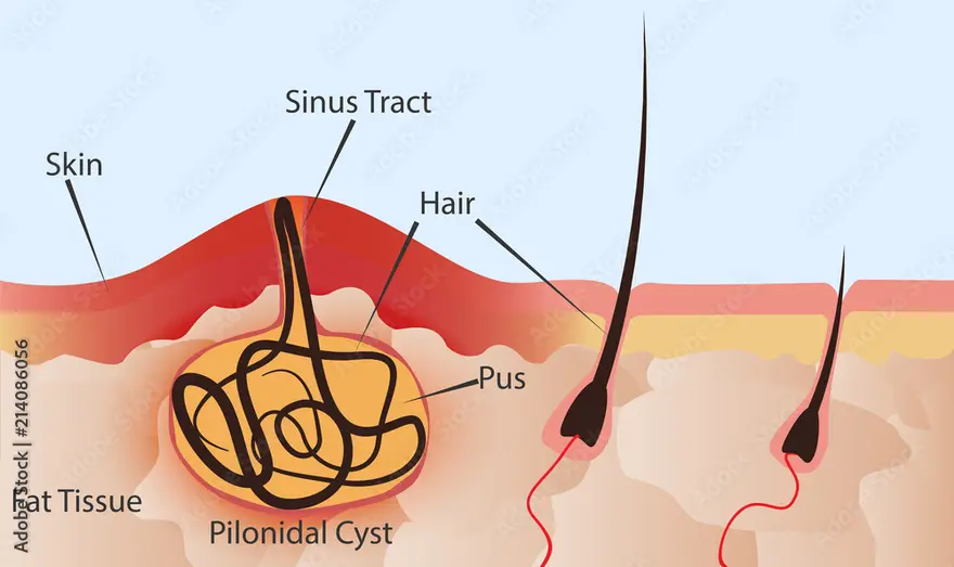 Pilonidal Sinus Diagram